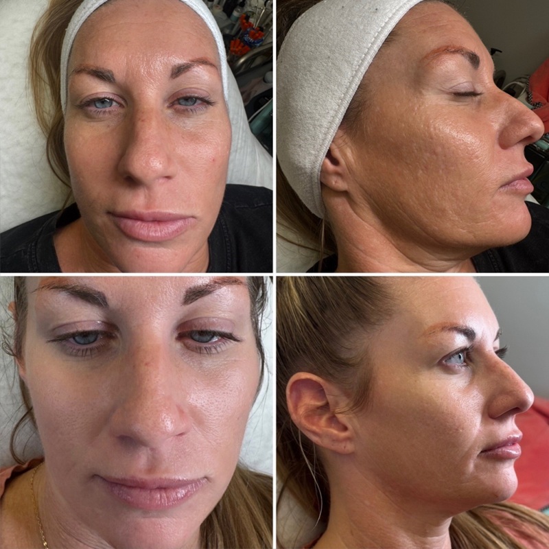 A woman’s face shown in before-and-after photos from front and side angles at BBY Spa, highlighting improved skin texture and tone after a facial treatment.