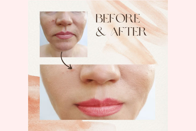 Close-up of a woman's lower face showing a "before" photo with uneven skin and an "after" photo with smoother, more even skin tone, highlighting the transformative results from BBY Spa.