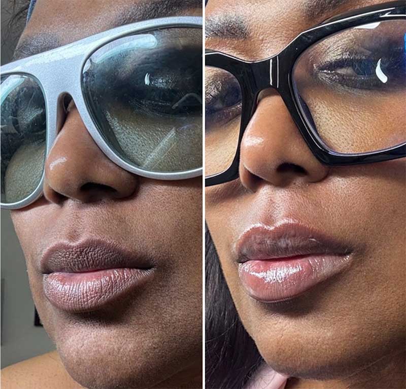 Side-by-side close-up of a person wearing glasses, showing dry, textured lips on the left and smooth, glossy lips on the right.