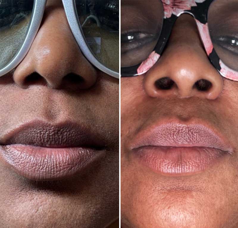 Side-by-side close-up of a person's nose and mouth wearing large sunglasses, showing lips with a dry, textured appearance.